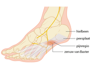 Fasciitis plantaris als beroepsziekte